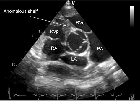 Quadricuspid Aortic Valve And Double Chambered Right Ventricle A Rare Combination Heart Asia