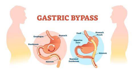 Gastric Bypass Bmi Of Texas