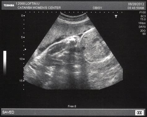 Ultrasound 30 Weeks Philip Leslie And Kayli