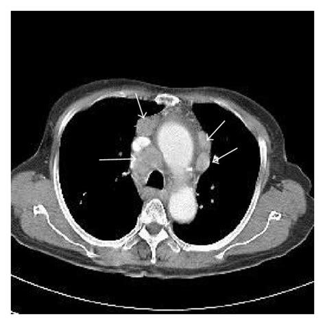 A A Chest Ct Shows Multiple Enlarged Lymph Nodes In Mediastinum B My