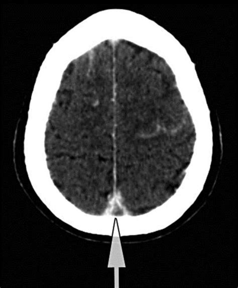 Cerebral Sinus Venous Thrombosis In The Superior Sagittal Sinus A