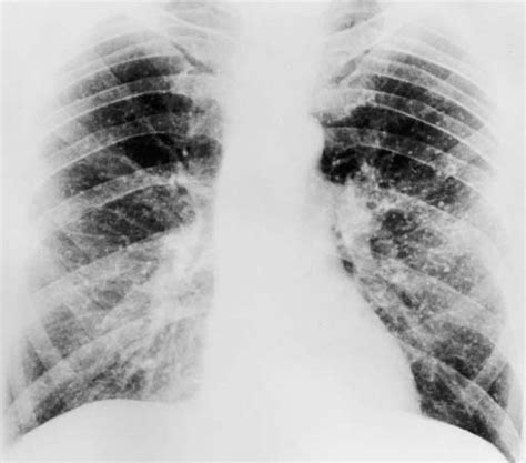 Chest Radiograph Demonstrating The Punctate Pulmonary Calcification As