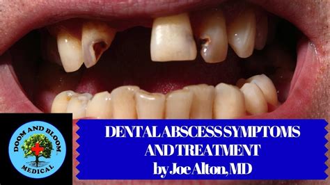 Dental Abscess Symptoms And Treatment In Survival Dental Clinic