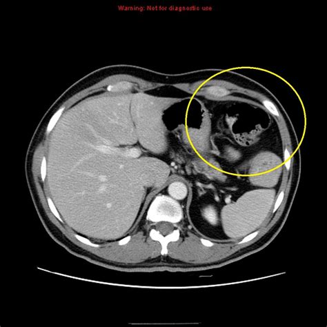 Stomach Cancer Ct Wikidoc