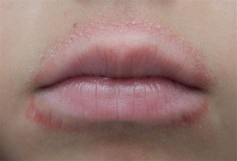 Yeast Infection On Lips Cheaper Than Retail Price Buy Clothing