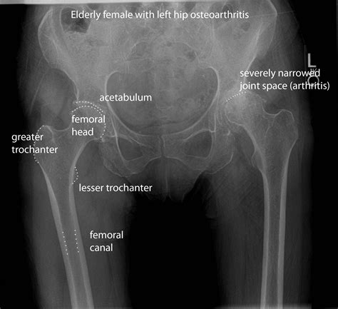 Pelvis Radiographic Anatomy Wikiradiography Vrogue Co