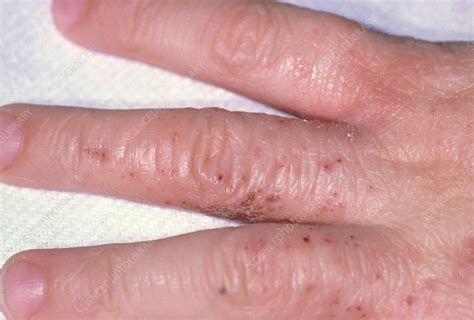 Identifying Skin Rashes Children