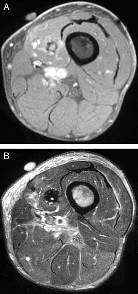 T1 Weighted Fat Saturated Axial Mri With Contrast A And T2 Weighted