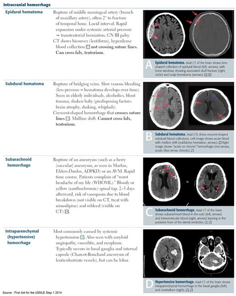 Patients with an epidural hematoma can remain conscious with minimal symptoms, can become drowsy, or can progress to a coma immediately following their injury based. Intracranial Hemorrhages (ICH) Epidural Hematoma ... | GrepMed