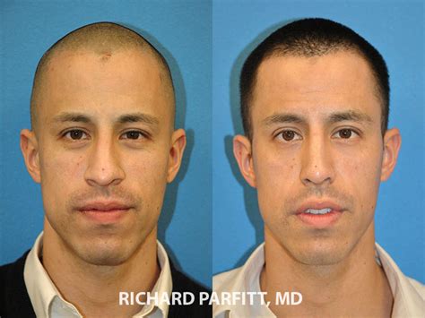 It is sometimes possible to take printouts of the pictures home, before making a final decision on whether or not you would like the results. Male Plastic Surgery Before and After Photos