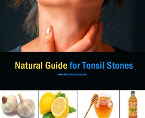 Tonsil Stones Removal Guide 2022