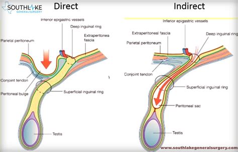 What All You Need To Know About Direct Vs Indirect Hernias Southlake