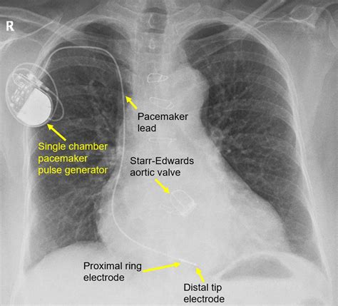 Implantable Cardioverter Defibrillator X Ray