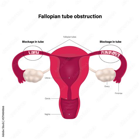 Fallopian Tube Obstruction Block Fallopian Tube Uterus And Uterine