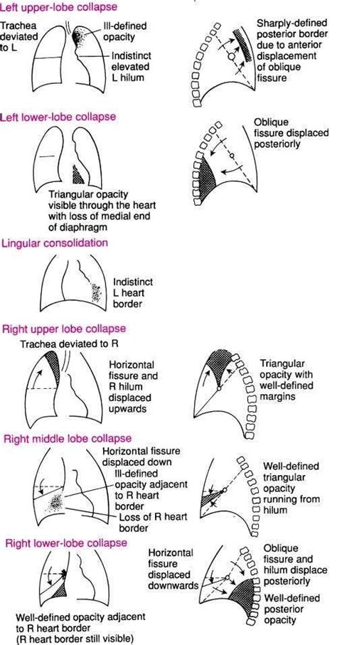 Approach To Chest X Ray And Interpretation