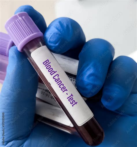 Blood Cancer Test Sample Leukemia Lymphoma And Myeloma Treatment For