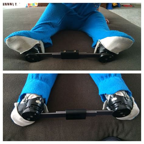 Have you learned anything throughout the years to make things easier on you? Pin on Club feet