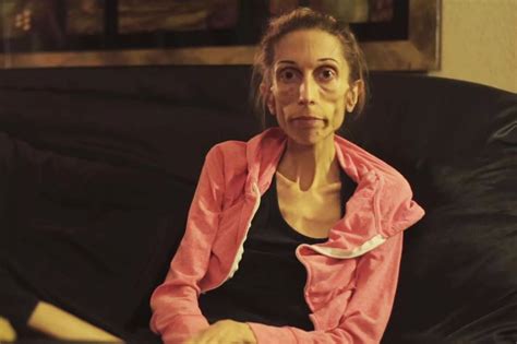 Rachael Farrokh 37 Developed Anorexia Nervosa More Than 10 Years Ago