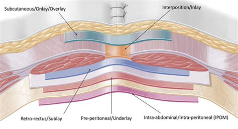 Abdominal Hernia Anatomy