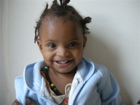 Success Mirtnesh From Ethiopia Raised 1500 To Fund Surgery For A