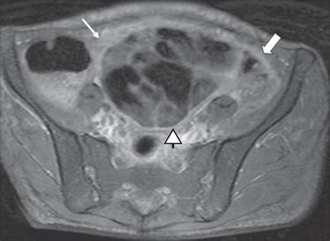 Scielo Brasil Abdominal Tuberculosis A Radiological Review With
