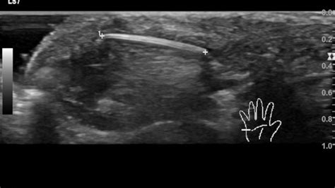 Foreign Body Internet Book Of Msk Ultrasound