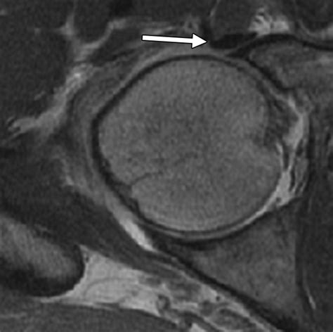 Labral Injuries Due To Iliopsoas Impingement Can They Be Diagnosed On