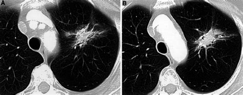 Non Small Cell Lung Cancer Manifesting As Poorly Marginated Mass A