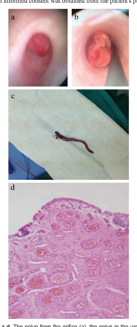 Figure 2 From Rare Fibroepithelial Polyp Extending Along The Ureter A