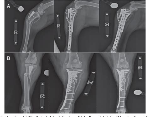 Pdf Treatment Of Tibial Diaphyseal Fractures Following Plateless