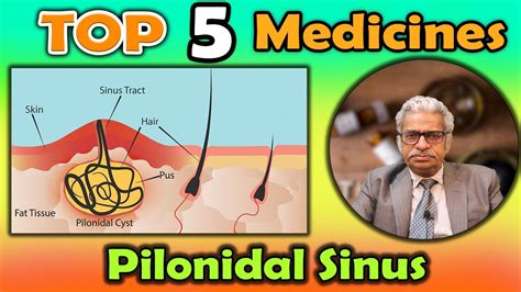 Top 5 Medicines For Pilonidal Sinus Dr Ps Tiwari Youtube
