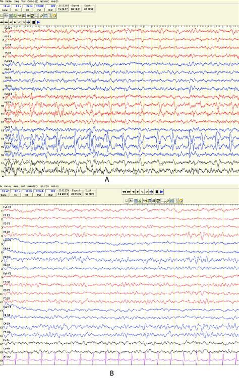 Electroencephalography A Initial Eeg Arrows Show Periodic Lateralized