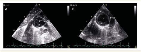 Figure 1 From Transthoracic Echocardiographic Guidance Of Minimally