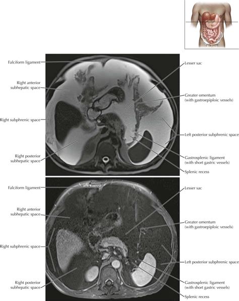 Peritoneal Cavity Radiology Key