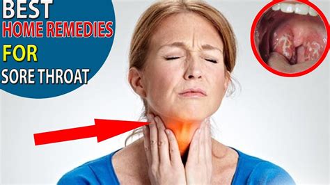 Sore Throat Best Home Remedies For Sore Throatshealth Solution Youtube