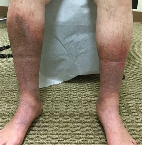 Loteria Bicamada Sentido Horário Skin Discoloration On Legs Pá Excesso