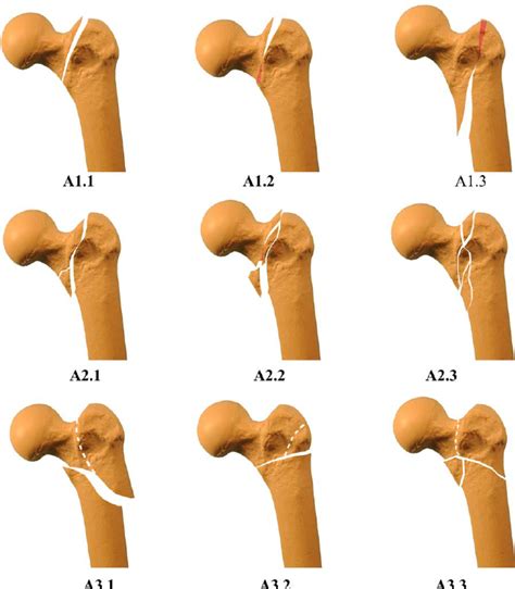 Ao Trauma Sicot Proximal Femoral Fractures Acute Management Gambaran