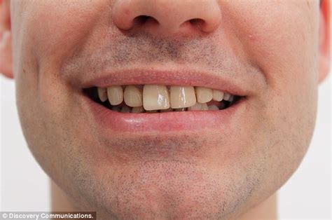 Extreme Beauty Disasters Shows Man Who Had Bad Teeth Veneers Repaired