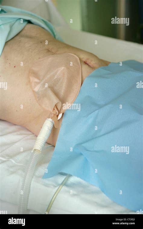 Colostomy Bag Hi Res Stock Photography And Images Alamy