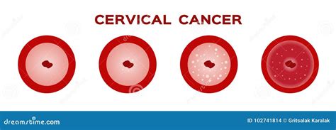 Cervical Cancer In Women Uterus Anatomy Vector Illustration Cartoondealer Com
