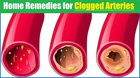 Webmd explains what causes arteries to harden, along with symptoms, tests, and treatments. Top Home Remedies for Clogged Arteries | Causes, Symptoms ...
