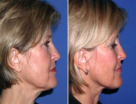 Short Scar Face Lift Gallery Ci Plastic Surgery