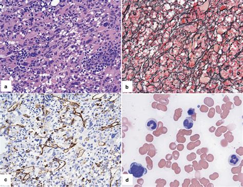 Bone Marrow Features Of Myelodysplastic Syndromes With Download