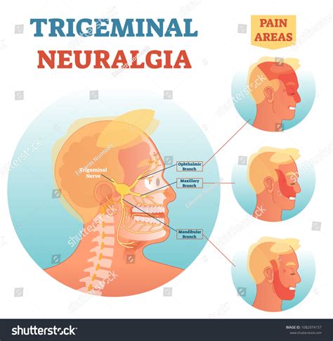 Trigeminal Neuralgia Medical Cross Section Anatomy Stock Vector