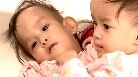 bliźnięta syjamskie niezwykła operacja rozdzielenia sióstr z bhutanu