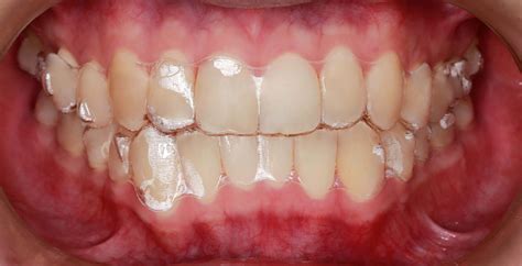 Invisalign Orthodontic 3c Dental Specializing In Braces