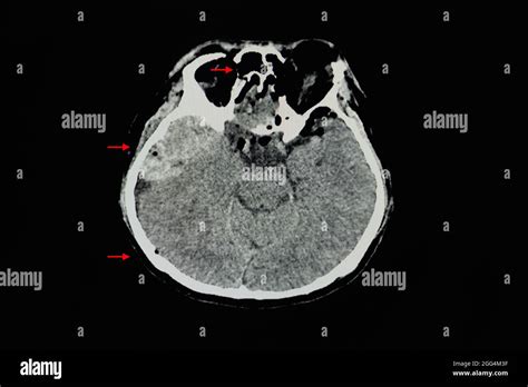 A Ct Brain Scan Of A Patient With Epidural Hematoma At Right Temporal