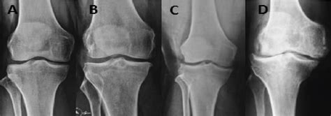 Anteroposterior Radiograph Of The Knee Joint Of The Participants A