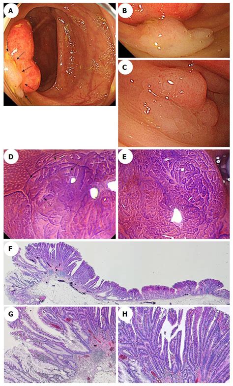 Endoscopic Diagnosis Of Sessile Serrated Adenomapolyp With And Without