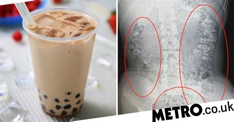 More Than 100 Bubble Tea Balls Found Stuck In Girls Body Metro News